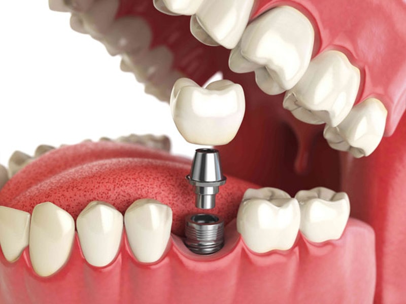 Протезирование зубов в Риге: насколько болезненна процедура